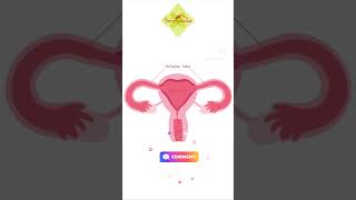 Fallopian tube blockage Treatment without operation fallopiantubeblockage uttarbastti infertility [upl. by Lotty45]