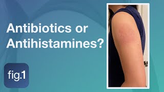 Should you treat COVID Arm with antihistamines [upl. by Nodyl]