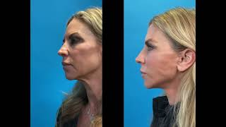 Advanced Facelift Dynamic Photos from Advanced Facelift Before amp Afters [upl. by Ellenoj553]