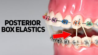 All About Posterior Box Elastics PBE httpswwwstraightsmilesolutionscom [upl. by Allain690]