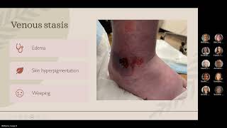 Empiric antibiotic selection for diabetic foot infections [upl. by Fassold697]