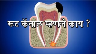 रूट कॅनाल म्हणजे काय   Root Canal Treatment in Marathi [upl. by Keffer]