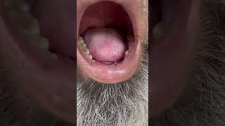 Tongue Fasiculations in a Patient of ALS [upl. by Enawyd]