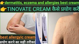 dermatitis eczema and allergies।।Tenovate cream।।best skin cream।।hindi review [upl. by Yuzik]