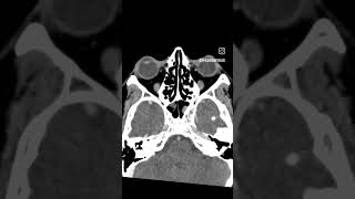 Case9 cect paranasal sinuses viral trending likesforlike commentsforcomments radiology [upl. by Dazhehs]