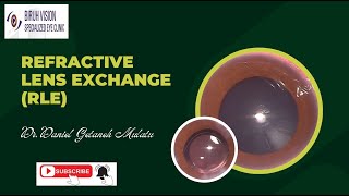 Refractive Lens Exchange with Monofocal IOL [upl. by Goetz]