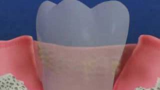 Periodontal Disease amp Treatment [upl. by Lathrop]