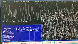 Myotonia and myotonic EMG discharges [upl. by Rhyne847]