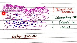 Lichen Sclerosus And Lichen Simplex Chronicus  Pathology [upl. by Vanni]