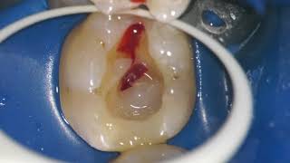 PULPITIS ENDODONTIC TREATMENT ROOT CANAL Intrapulpal anestesia HOT TOOTH [upl. by Howlan]