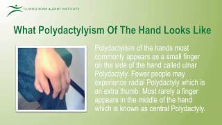 Polydactyly Treatment [upl. by Eon]