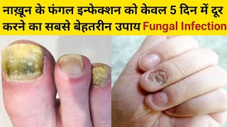 नाख़ून में फंगस इन्फेक्शन का इलाज  Nakhun me fungal infection  Onychomycosis nailfungalinfection [upl. by Berrie]