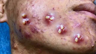 Big Cystic Acne Blackheads Extraction Blackheads amp Milia Whiteheads Removal Pimple Popping [upl. by Mehala891]