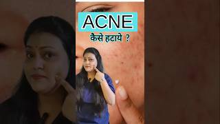 Homeopathic medicine for acne youtubeshorts acne acnetreatment [upl. by Emorej280]