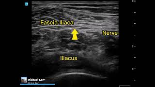 Femoral nerve block  Commenting on technique [upl. by Noiramaj]