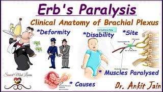 Erbs paralysisBrachial Plexus InjuryErbs PalsySimplified Anatomy Deformity Disabilityin hindi [upl. by Ahtiuqal]