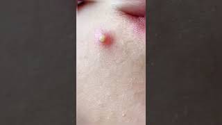 Huge Blackheads Extraction Big Cystic Pimple BlackheadsampWhiteheads Removal Popping 106 Shorts [upl. by Els401]