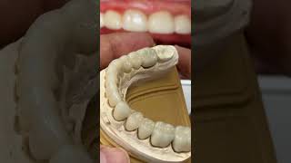 Teeth Prep and final full mouth restoration with Metal free also Metal ceramics [upl. by Gorrian]