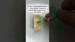 GEFÄHRLICHER AUSSCHLAG  Wann du sofort zum Arzt musst 👩‍⚕️👶 kindermedizin elterntipps [upl. by Haym]