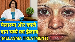 Dark Spots Pigmentation दाग धब्बे  Melasma का पूरा ईलाज [upl. by Balch]