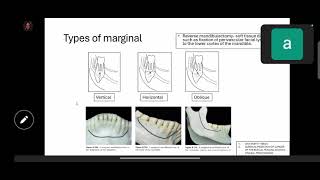 indications of mandibular resection and reconstruction [upl. by Neill259]