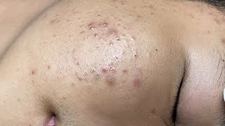 ACNE TREATMENT VU QUYNH MI  Blackheads On Boy Face 2024FULL [upl. by Retsub]