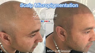 2 Scalp Micropigmentation  Before amp After 1st and 2nd Session [upl. by Eey454]