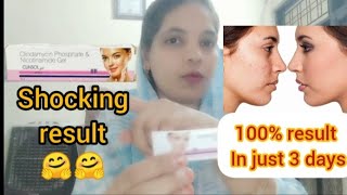 Clinsol gel review in Hindi  Clinsol gel  Pimple free skin naazkhanofficial [upl. by Ybbed]