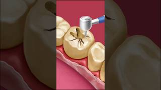 Dental Care ASMR  Gentle Tooth Cleaning Animation  tartar remove amp dental filling treatment [upl. by Linsk478]