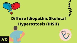 Diffuse Idiopathic Skeletal Hyperostosis DISH Causes Signs and Symptoms Diagnosis and Treatment [upl. by Hilly399]