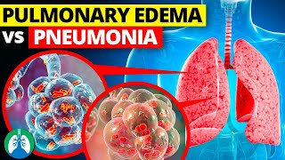 Pulmonary Edema vs Pneumonia [upl. by Anaerdna]