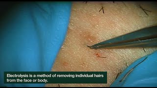 Electrolysis Ingrown Hair Removal  CLOSEUP  Here is how Electrolysis works  Jade Clinics [upl. by Mordecai]