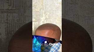 Scalp micropigmentation brings back your hairline scalpmicropigmentation scalpmicro [upl. by Aiyram]