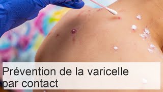 Peuton attraper la varicelle en côtoyant un enfant malade [upl. by Airamanna792]