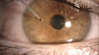 corneal foreign body removal like a boss [upl. by Diannne743]