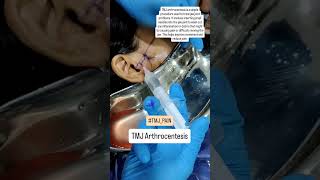 TMJ Arthrocentesis For TMJ Pain Relief  Dr Parit Ladani [upl. by Amelus]