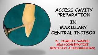 Incisor access opening Incisor access cavity RCT Easy endodontics for maxillary incisor [upl. by Dale]