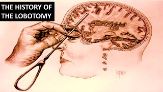 The Rise and Fall of The Lobotomy [upl. by Roddie483]