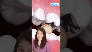 Tooth Fracture  Avoid Tooth fracture Dental Crown shorts dental viralvideo fracture trending [upl. by Kerge]