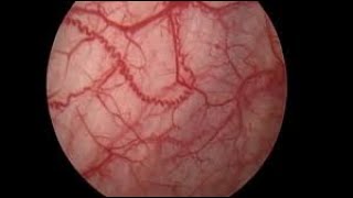 Cystoscopy with Hydrodistention for Interstitial Cystitis patients [upl. by Intihw601]