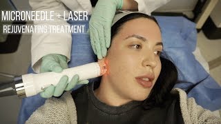 MicroNeedling and Laser Facial Vlog  Viva amp Vivace Treatment  Solange Nicole [upl. by Athalla641]