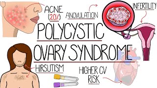 Polycystic Ovary Syndrome Made Easy PCOS Explained [upl. by Kimmy543]