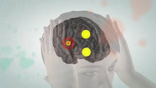 Animated video illustrating the pathophysiology of migraine [upl. by Ramona]