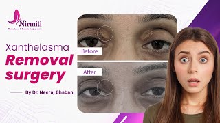 What is Xanthelasma Xanthelasma Removal surgery [upl. by Sulamith572]