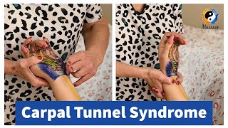 Carpal Tunnel Syndrome [upl. by Iduj]