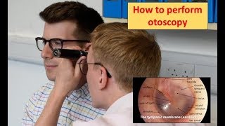 How to perform Otoscopy Ear Exam [upl. by Arty457]