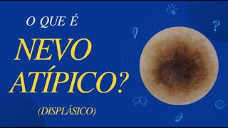 NEVO MELANOCÍTICO ATÍPICO DISPLÁSICO  O que é Por Luiz Gameiro dermatologista [upl. by Ymme]