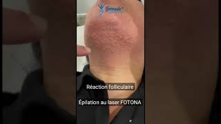 Epilation au laser FOTONAVous pouvez noter la réaction folliculaire end point [upl. by Adnorhs]