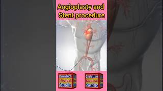 Angioplasty technique  Stent and Angioplasty procedure shorts [upl. by Reibaj]