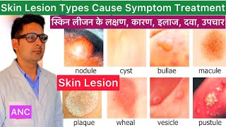 Skin Lesions Cause Symptom Diagnosis Treatment in Hindi  Skin Lesion  What is Skin Lesion  Skin [upl. by Lemak734]